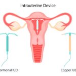 IUD-contraception. Control