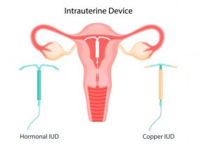 IUD-contraception. Control