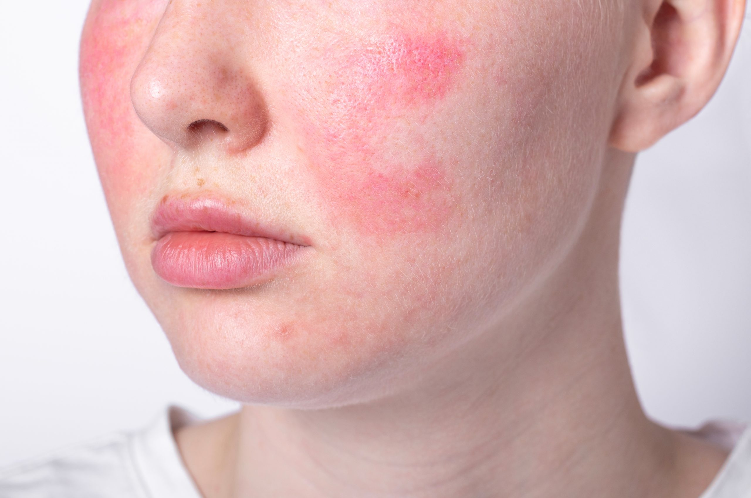 rosacea treatment Ireland