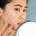 Online acne prescription