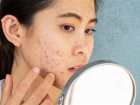 Online acne prescription