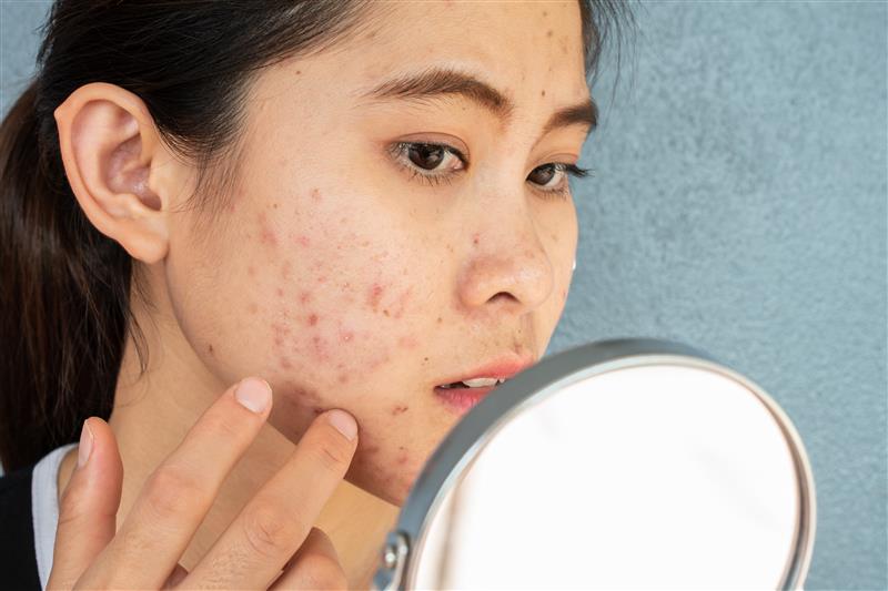 Online acne prescription