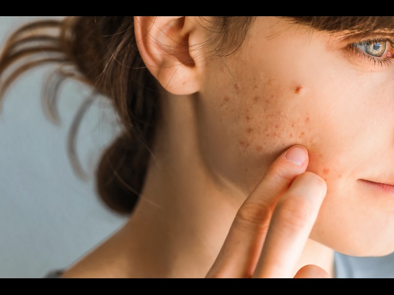 Prescription acne cream Differin