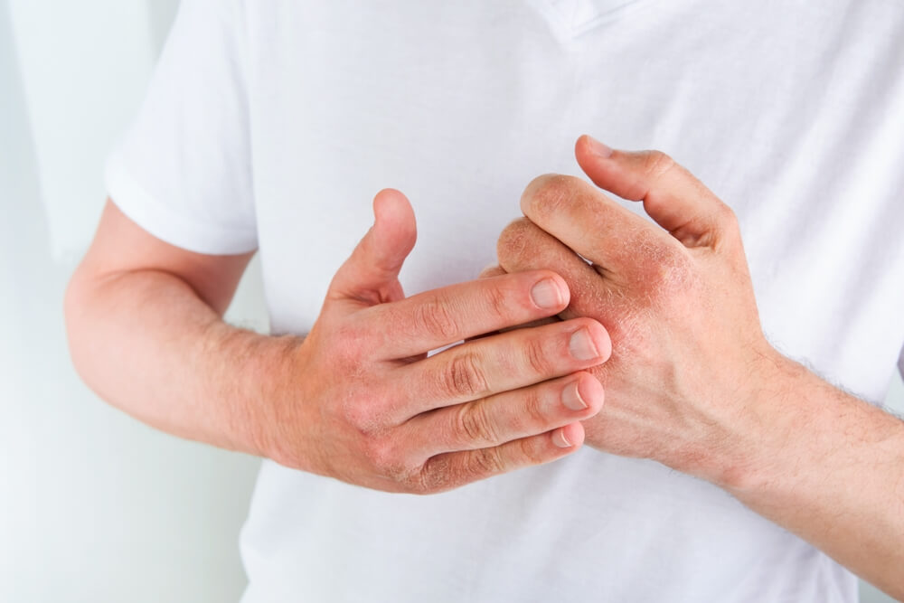 Eczema prescription online