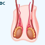 Affordable Vasectomy in Dublin | Online Doctor Ireland