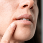 Cold Sore Treatment & Fast Relief in Ireland | Expert Guide