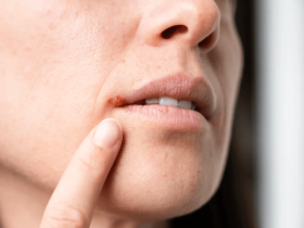 Cold Sore Treatment & Fast Relief in Ireland | Expert Guide