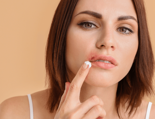 5 Cold Sore Causes & Treatments: Ireland Guide
