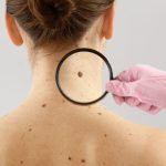 Could That Spot Be Skin Cancer? A Guide for Ireland
