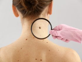 Could That Spot Be Skin Cancer? A Guide for Ireland