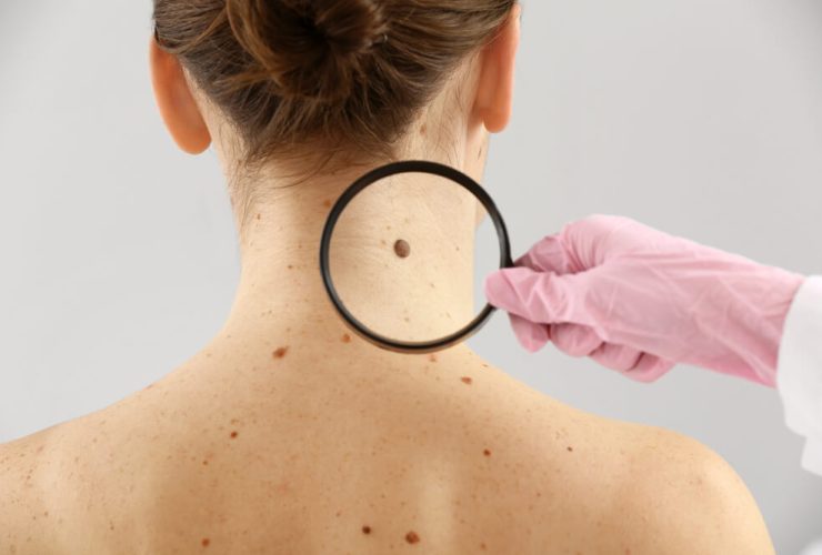 Could That Spot Be Skin Cancer? A Guide for Ireland