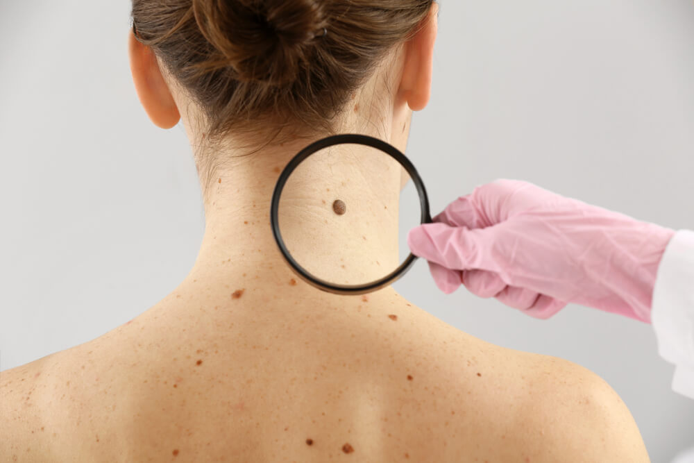 Could That Spot Be Skin Cancer? A Guide for Ireland