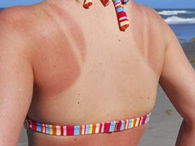 How to Fade Uneven Tan Lines: Safe Skincare