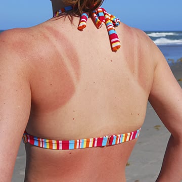 How to Fade Uneven Tan Lines: Safe Skincare