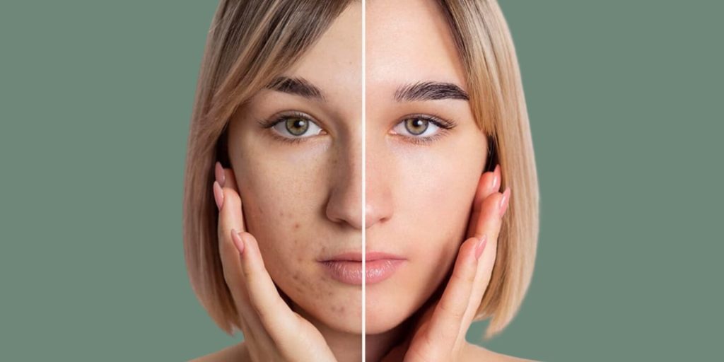 Tretinoin Cream Ireland | Online Prescription €20 | 2 Hr